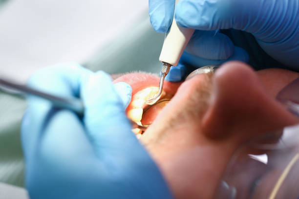 Best Emergency Dentist for Knocked-Out Tooth in Litchfield Beach, SC